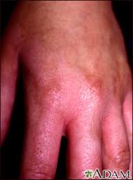 Image result for dermatitis contacta allergica