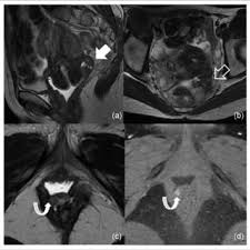 Cancers arising in ovarian or extraovarian endometriosis is. Pdf Imaging Techniques In Endometriosis