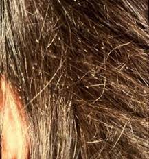 Lice do not care if the hair is clean or dirty, much less straight or curly. How To Get Rid Of Head Lice And Nits With Vinegar And Conditioner Lice Nits Head Lice Nits Head Louse
