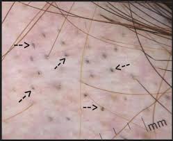 Reduces itchiness, dryness, redness of scalp, nourishes hair follicles. Black Dots In Alopecia Areata Donovan Hair Clinic