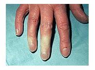 Dacă amorțirea mâinilor este, de asemenea, însoțită de tulburări de vorbire și vedere, o ambulanță trebuie chemată imediat! Fenomenul Raynaud