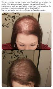 Vous Pouvez Voir Le Pouvoir De Monat You Can See The Power Of Monat Monat Hair Monat Hair Growth Monet Hair Products