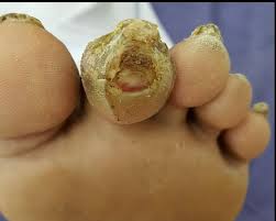 Image result for diabetic toes