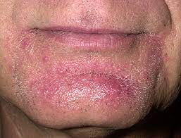 Preventing, Treating & Curing: Razor Burn, Redness, Shaving Irritation,  Bumps & Ingrown Hairs | The Shaving Shack Blog