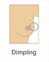 Basically, dimpling can mean the tissue is being pulled down by a form of cancer growing inside the breast, says dr. These 9 Pics Showing The Common Signs Of Breast Cancer Are A Must See For Everyone Bored Panda