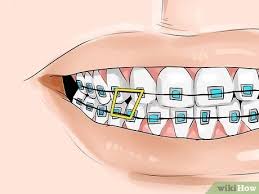 In other words, an overjet (what orthodontists call an overbite) is a front to back problem. How To Connect A Rubber Band To Your Braces 12 Steps