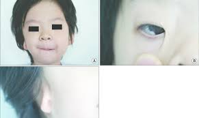 4-year-old male with Goldenhar syndrome. (A) Facial asy mmetry of the...