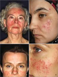 Check spelling or type a new query. Demodex Mites And Demodicosis Springerlink