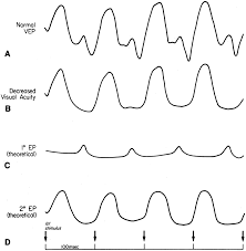 Image result for Decreased Visual Acuity