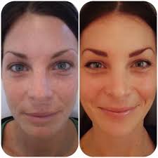 Before And After Perfect Peel Chemical Peel Even Skin Tone Skin Tones