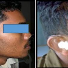 PDF) Secondary correction of the post-traumatic deformity: A clinical study