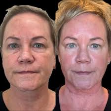 Incredible results from CO2 Laser by Jenna 🙌 This option is ideal for  those looking to transform their skin and diminish the appearance of  imperfections resulting from acne, injury, or aging. Although