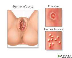 If you suspect you have herpes and would like to speak to a physician and/or get tested and treated online, book an appointment with a plushcare doctor now. Genital Sores Female Information Mount Sinai New York