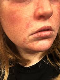 Image result for ekzema face