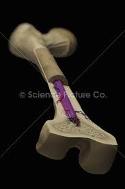 The callus is slowly broken down by osteoclasts until the bone is returned to its original shape. Internal Anatomy Of Bone Femur Spc Id 2899 Science 3d Illustration