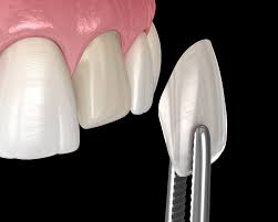Dental Implants vs Veneers | Penn Dental Family Practice