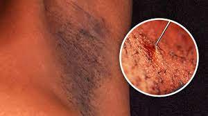 Ingrown hairs can happen anywhere, including your armpit. How To Get Rid Of Dark Spots On Armpits Ingrown Hair Treatment Youtube