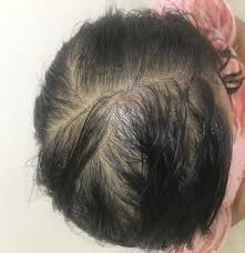 Having said that, here are a few tips that can help control hair fall after delivery. Post Pregnancy Hair Loss Pos Partum Alopecia Neo Follicle Transplant Hair Loss Treatment Clinic Neo Follicle Transplant