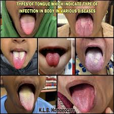 Image result for yellow tongue infection