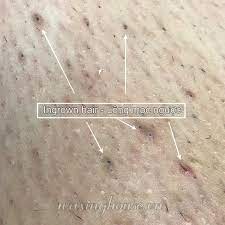 These methods can lead to ingrown hairs and infections though, so most gynecologists warn against them and recommend trimming or letting it be instead. Ingrown Hair Causes And How To Treat Waxing House