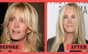 Do plastic surgeons elect to undergo cosmetic surgery more than the average american? 31 Plastic Surgery Gone Wrong Pictures That Will Make You Feel Uncomfortable But You Can T Look Away Right