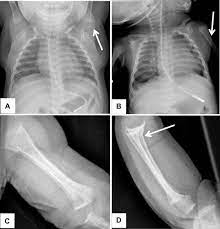 Metabolic Bone Disease Of Prematurity Sciencedirect