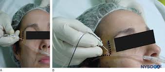 Image result for Ear Nerve Block
