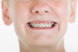 They will ask you if you want colors on there braces. Why Shouldn T I Use Diy Braces Flenniken Family Dentistry