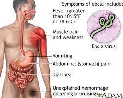 Ebola virus disease (evd) is a rare and deadly disease in people and nonhuman primates. Ebola Virus Medlineplus Medical Encyclopedia Image