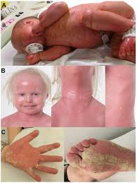 Image result for Ichthyosis