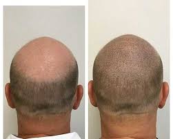 Ali safieddine leading the area for 7 years most successful procedure . Benefits Of Scalp Micropigmentation Smp Untitled