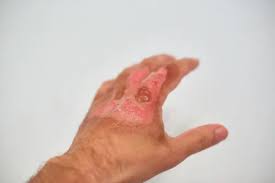 Image result for Hand Injury