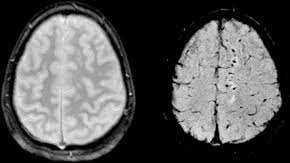 Diffuse Axonal Injury Wikipedia