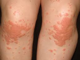 Check spelling or type a new query. Papular Acrodermatitis Of Childhood Dermnet Nz