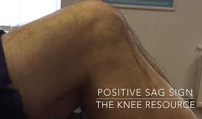 Image result for PCL Sag Test