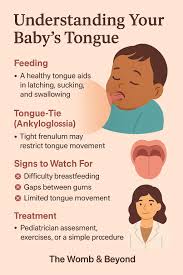 Image result for Ankyloglossia