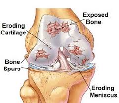 Webmd shares the top causes. Sharp Knee Pain Causes Symptoms Treatment