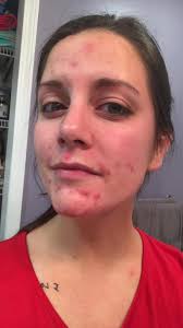 I am struggling! 19 weeks pregnant and for the last month or so my acne has  been horrible. I've never had anything like this before