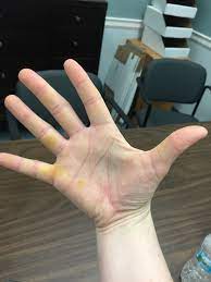 ​ the best diet for liver disease and diabetes Hand Turning Yellow November 2018 Babies Forums What To Expect