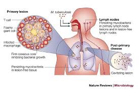The most commonly used diagnostic tool for tuberculosis is a skin test, though blood tests are becoming more commonplace. Tuberculosis A Problem With Persistence Nature Reviews Microbiology