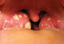 Strep throats infection can cause white spots on throat as well as inflammation and pain in the tonsils and throat area. Tonsillitis Kids Britannica Kids Homework Help