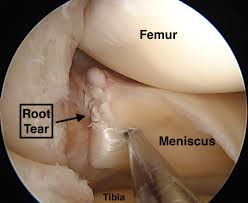 Can a torn meniscus get worse over time. Root Tears Of The Meniscus Video Town Center Orthopaedic Associates