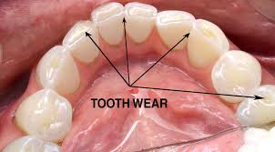 Image result for Occlusal