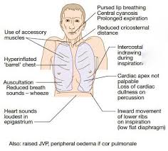 Medicinexplained Copd History And Physical Findings Respiratory Therapy Student Copd Copd Stages