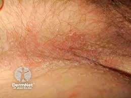 Image result for sore skin in the groin area