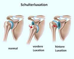 Schulterluxation Physiozentrum