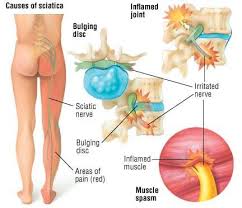 In some cases it can be a local cause while in others it can be a systemic disease. Sciatica Leg Pain Back Pain Neuropathy Spinal Stenosis Disk
