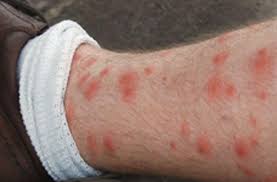 Image result for mite bites on humans