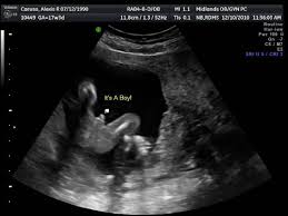 Bacaan air ketuban bacaan air ketuban klinik siti pristana facebook. Ini Antara Sebab Kenapa Detail Scan Untuk Bayi Lebih Penting Dari Scan 3d4d5d