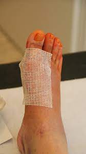 Wundheilung Und Verbandswechsel Ogam Orthopadie